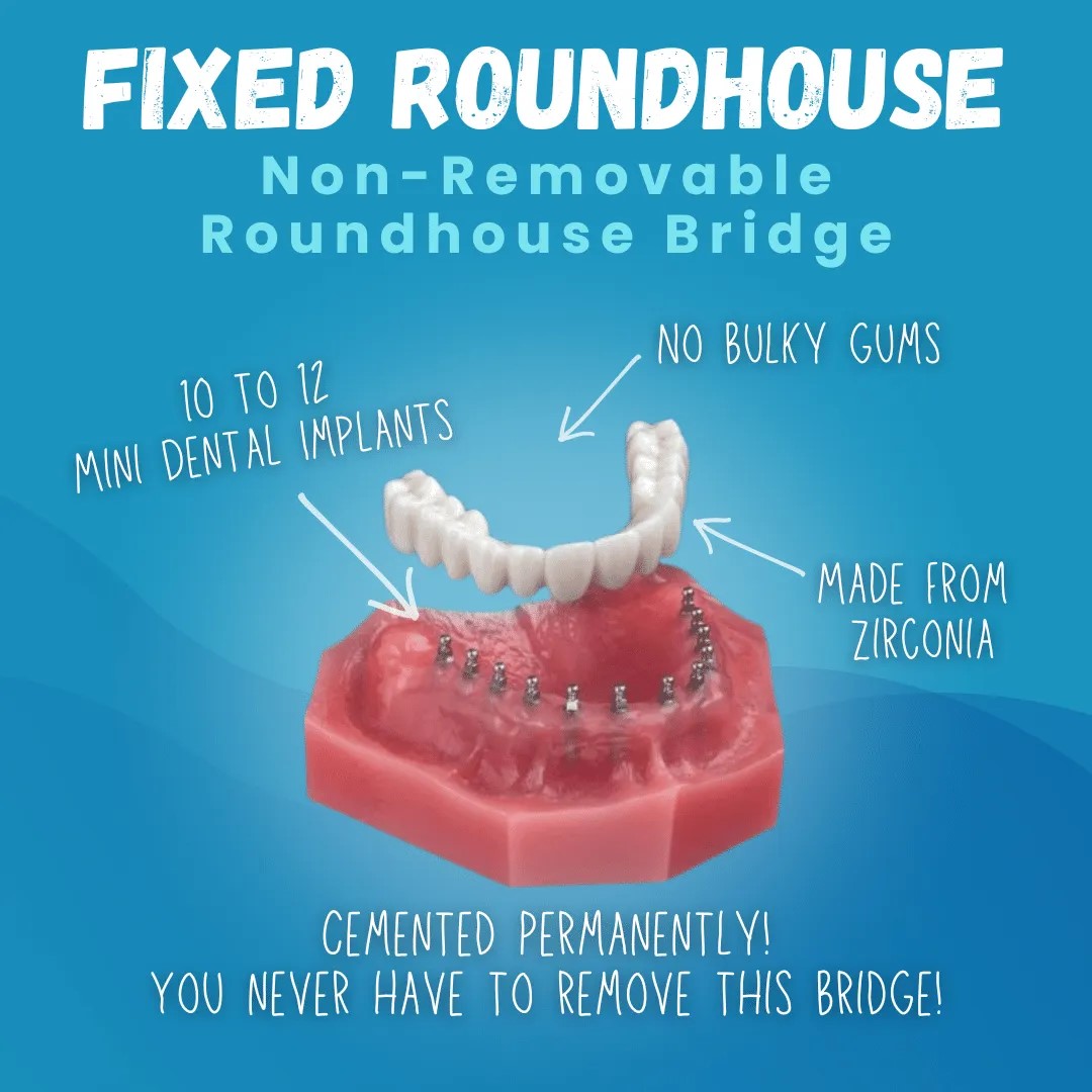 Fixed Roundhouse Denture