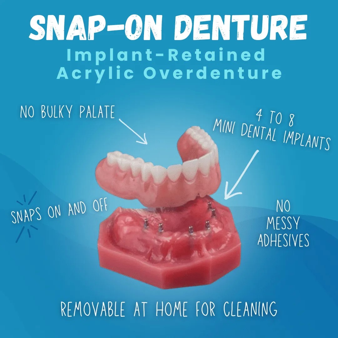 Snap On Dentures