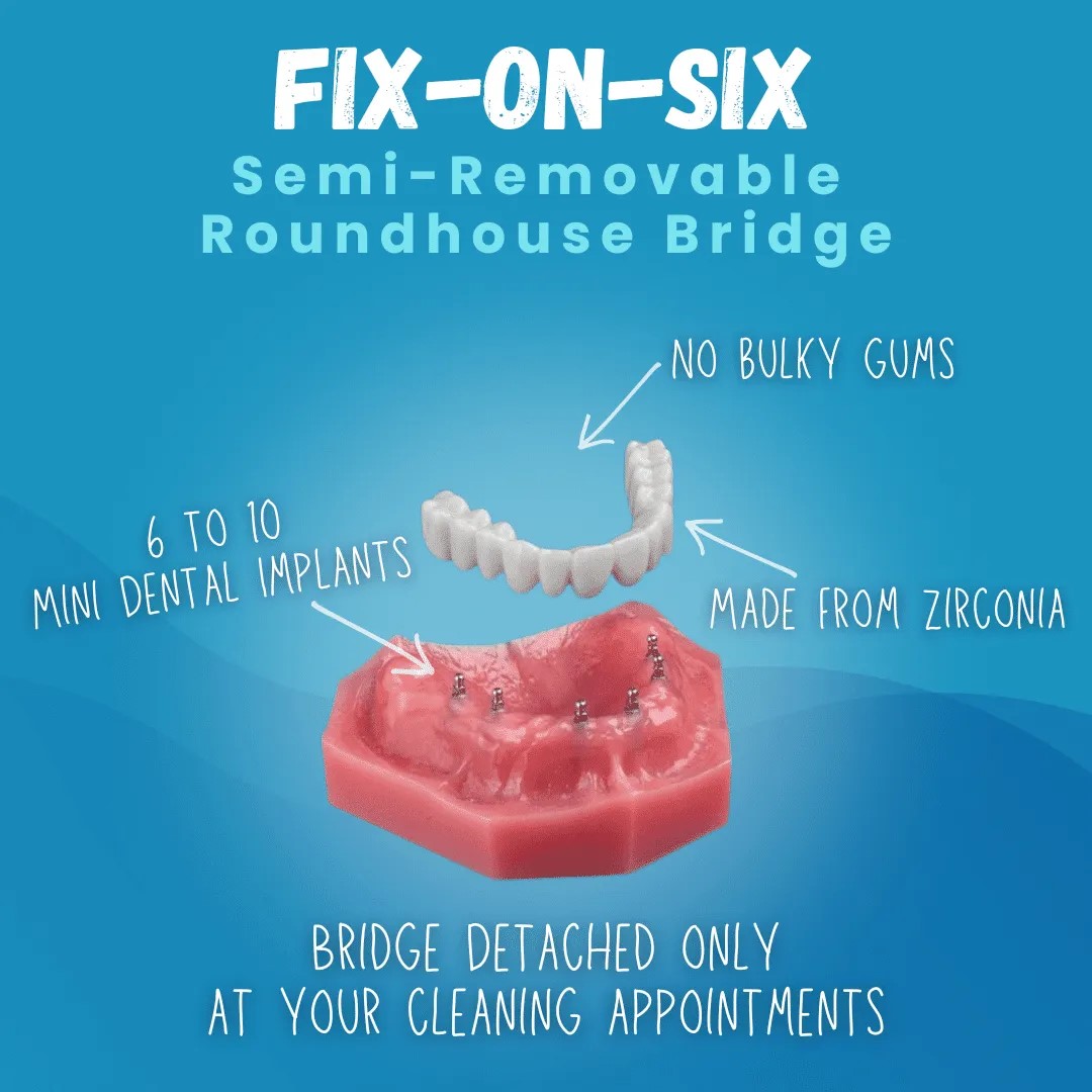 Fix on Six Denture